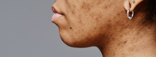 Pigmentation & Dark Spots: Root Cause as per Ayurveda