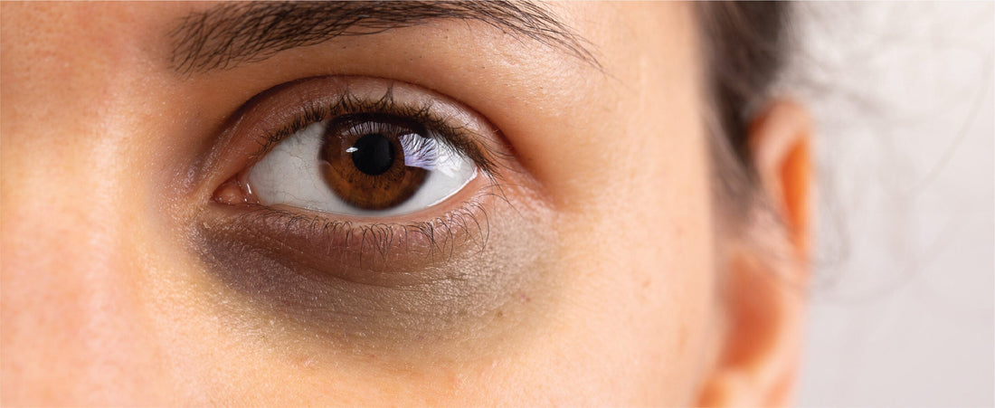 Under-Eye Dark Circles Ayurvedic Causes and Remedies